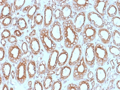 FFPE human renal cell carcinoma sections stained with 100 ul anti-Calnexin (clone CANX/1543) at 1:400. HIER epitope retrieval prior to staining was performed in 10mM Citrate, pH 6.0.